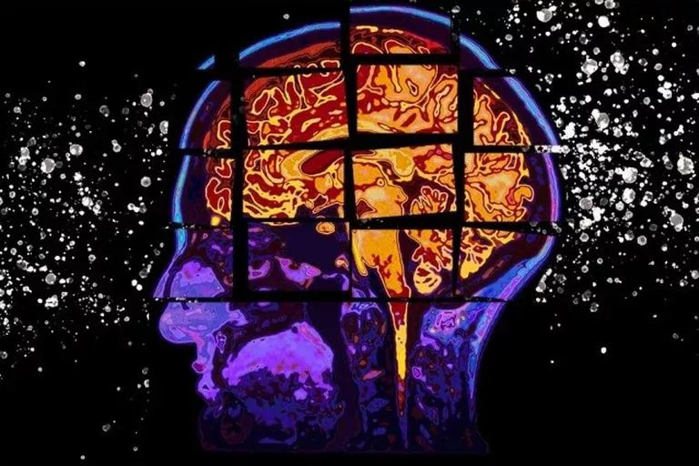 Alzheimer